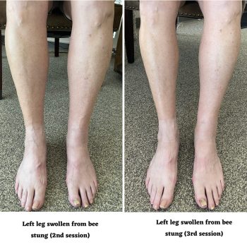 Effective Bee Sting Swelling Reduction: MLD at Marin Massage Therapy